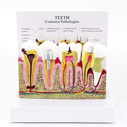 Dental Plastic Periodontal Teeth Human Medical Decay Common Pathologies Model by Skeleton King