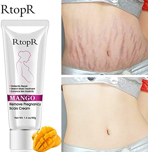 stretch mark cream removal