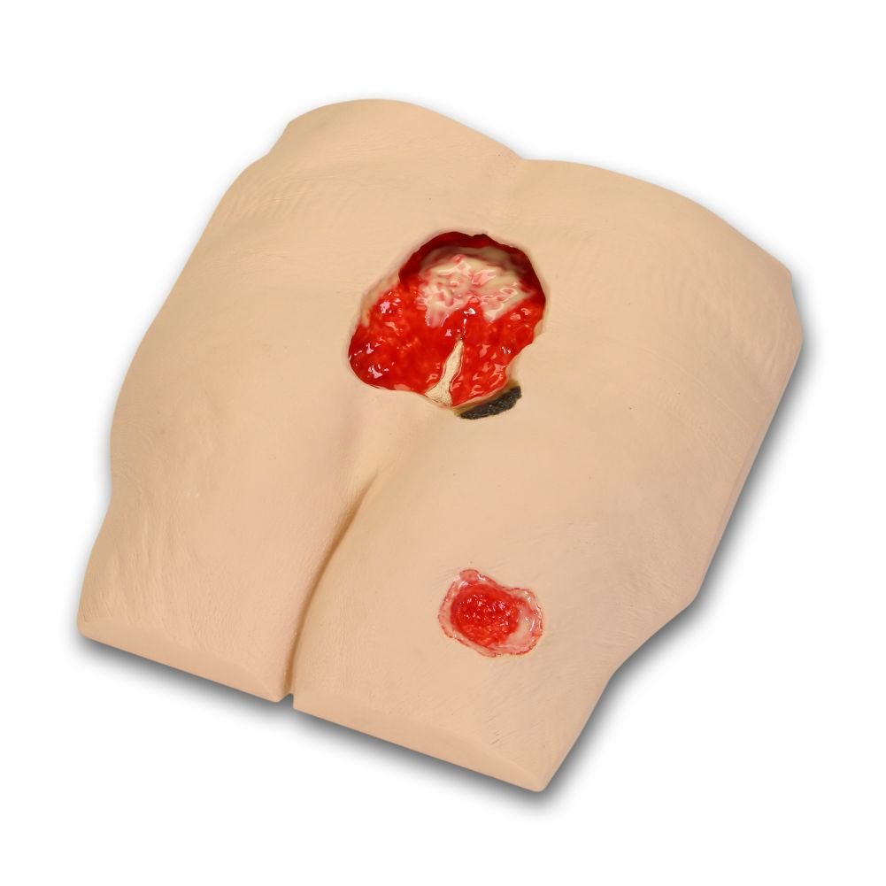 Best Vacuum Assisted Closure Device