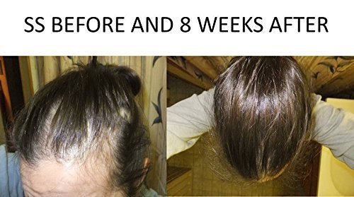 Spare My Hair Vitamins Vegan Hair Growth Supplement With Biotin