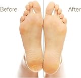 Citystores Pumice Stone Feet Callus Remover Dry Hard Skin Cracked Heels view 4