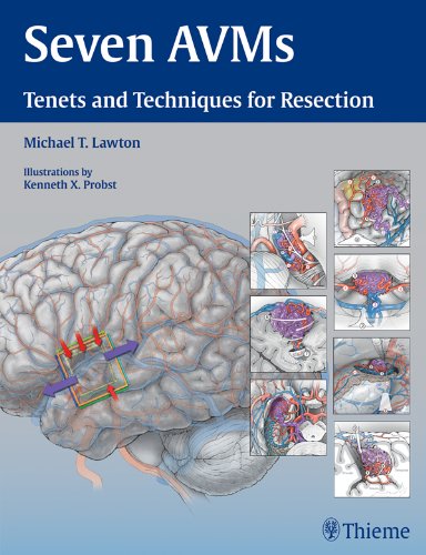 Seven AVMs: Tenets and Techniques for Resection - medicalbooks.filipinodoctors.org