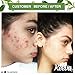 Keeva Organics Acne Treatment Cream With Secret TEA TREE OIL Formula - Perfect For Acne Scar Removal, Fighting Breakouts, Spots, Cystic Acne - See Results in Days Without Dry Skin (6oz)