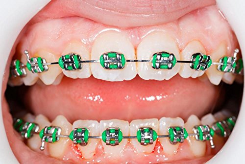 Top 5 Best fake braces that stick on your teeth prime for ...