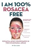 I Am 100% Rosacea Free: ROSACEA ACNE IS BLOCKAGES IN THE SINUS/NASAL AREAS