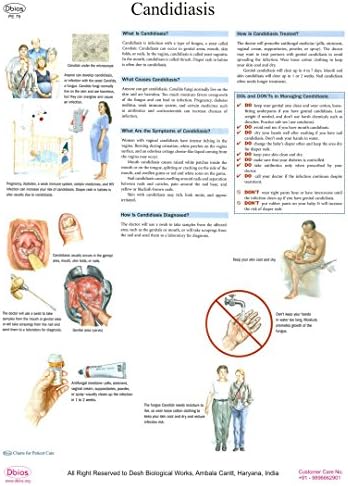 Dbios Digitally Printed Candidiasis Limanated Education Wall Charts