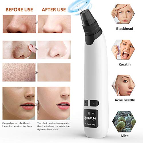Blackhead Remover Vacuum, USB Rechargeable Facial Pore Cleaner Electric Acne Comedone Extractor Kit with Hot Compress Including 4 Suction Head and 3 Adjustable Suction for Women and Men