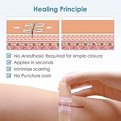 SEABIRD Emergency Wound Closure Device, Zip Sutures