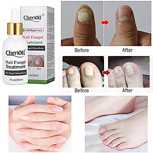 Nail Fungus Treatments, Nail Antifungal Treatment, Fungus Stop, Toenail