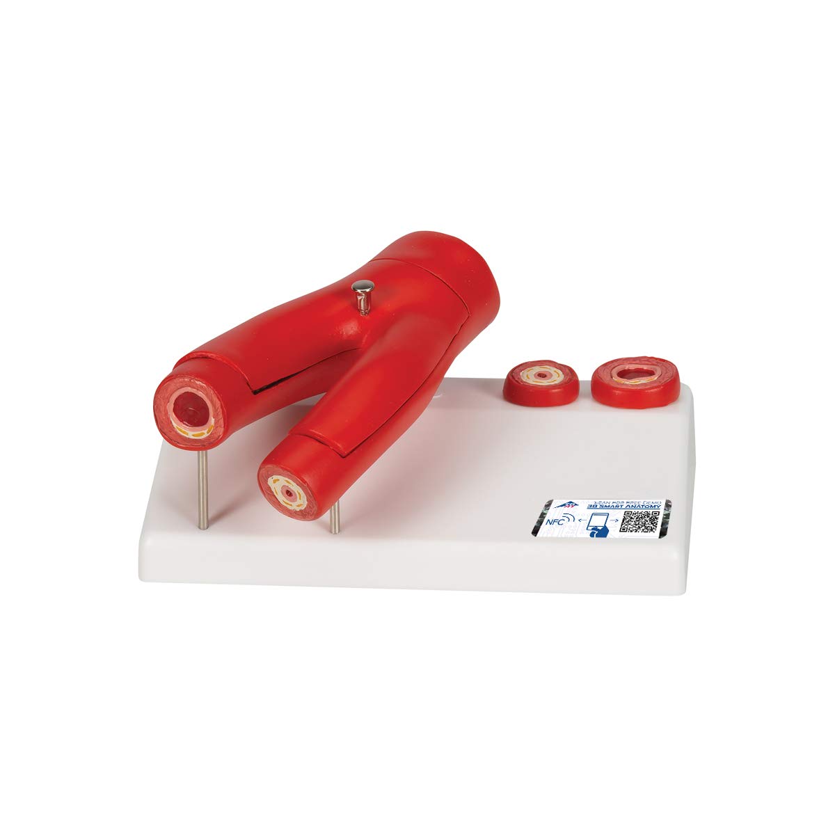 3B Scientific G40 Human Anatomy - Arteriosclerosis Model with Cross Section of Artery, 2 Part + free Anatomy App - 3B Smart Anatomy