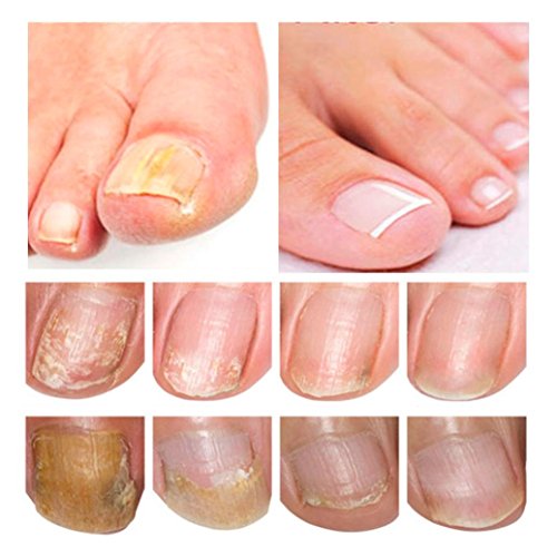 Nail Toenail Fungus Treatment, Fungus Stop Effective Anti Against Nail Fungus Solution Set (15ml)