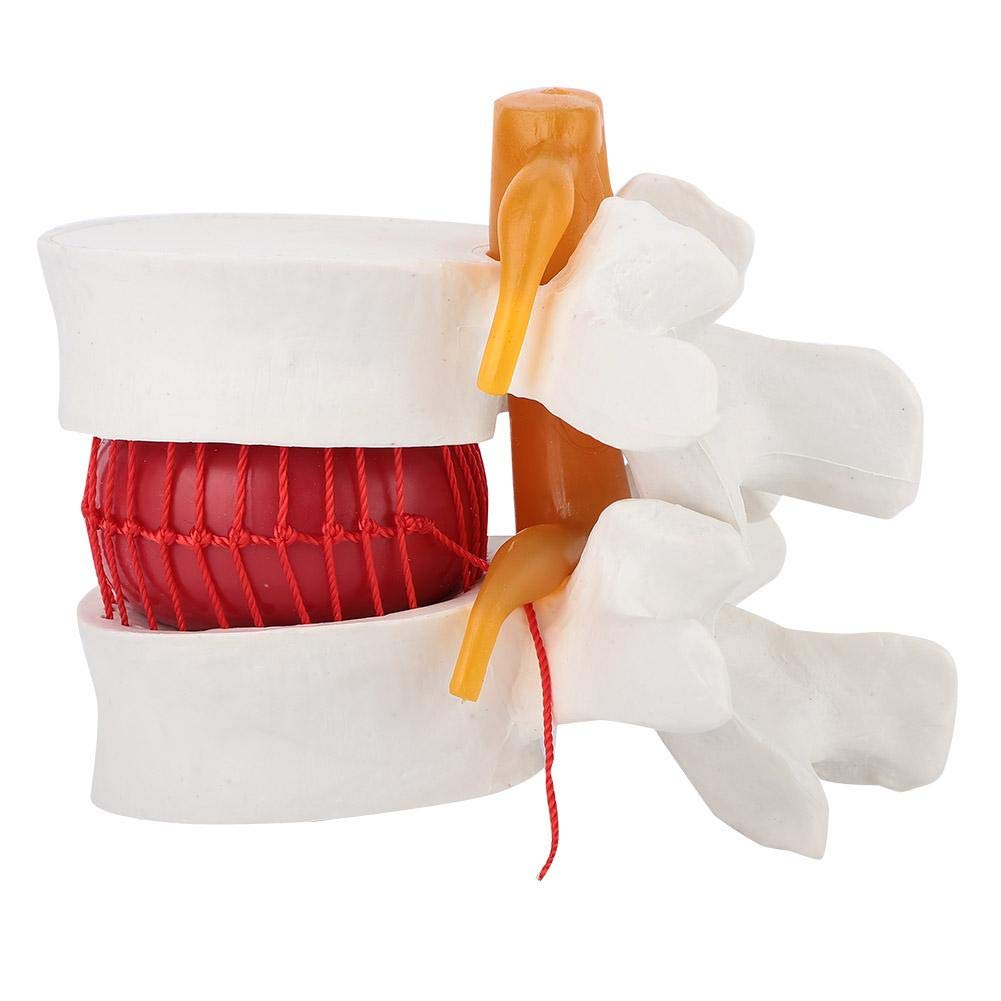 Human Lumbar Model Human Skeleton Model Spine Model,1:1.5 Demonstration Model of Lumbar Vertebral Spine Human Lumbar Disc Herniation Model