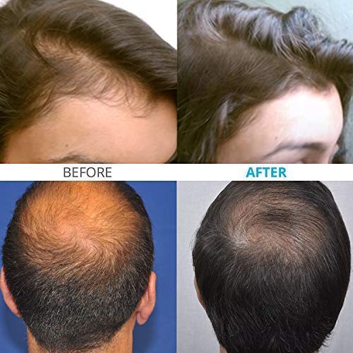 Theradome PRO LH80 Medical Grade Laser Hair Growth Helmet FDA