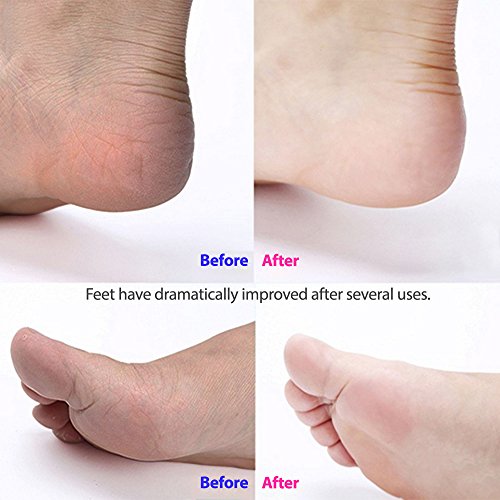 Rechargeable Pedicure Foot File Callous Remover - Electronic Foot Scrubber Removes Callus, Cracked, Dead, Hard Skin- A Must Have Foot Care Pedicure Tool (Purple) - Thumbnail 3