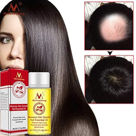 Buy Shreeyas 2018 Fast Powerful Hair Growth Essence Hair Loss