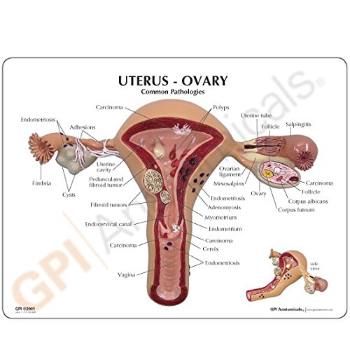 Uterus Ovary Anatomical Model With Pathologies