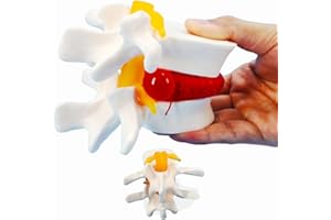 Veipho Human Anatomical Lumbar Disc Herniation Model, Movable Human Lumbar Disc Herniation Model, 1.5 Times Life Size Lumbar Disc Model for Teaching, Learning and Science Education