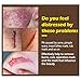 Scar Cream,Scar Removal Cream Gel,Scar Treatment,Scar Repair Cream,Acne Spots Treatment,Scar Gel Remove & Lighten Old & New Scars,Acne Scar Removal Cream,Face Skin Repair Cream