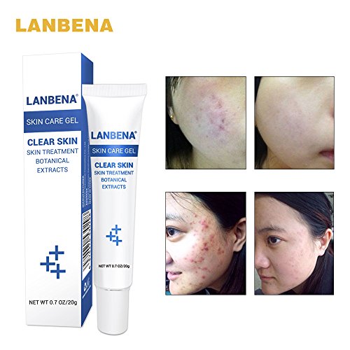 Acne Treatment Gel Acne Cleaning Cream Blackhead Remover Acne Spots Face Acne Scars Skin Care Repair Comedone Pimple
