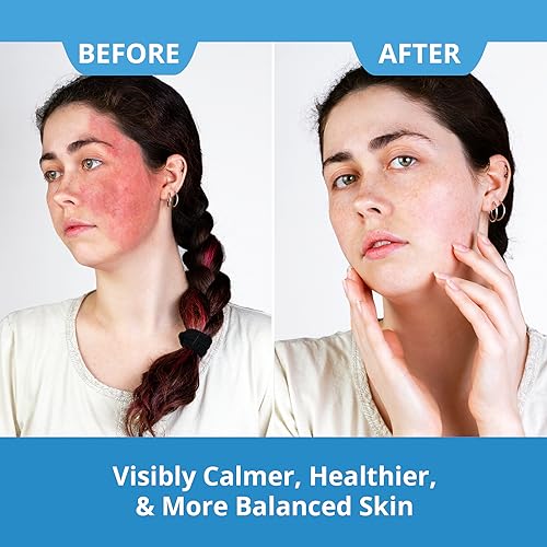 DermaChange Shingles Cream Anti Itch Lotion & Rash Cream for Adults