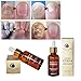 Mchoice Nail Treatment Essence Nail and Foot Whitening Toe Nail Fungus Removal