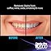 DentaPro 2000 3D Teeth Whitening Kit – Deluxe Addition Includes LED Light, (2) 5ml Gel Syringes, Custom Moldable Tray (2), Vitamin E Swab (2), Shade Guide – See Results After Just One Use!