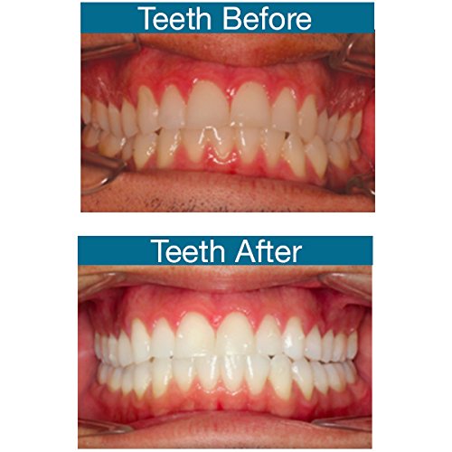 EverSmile WhiteFoam Invisalign Cleaner, Clear Retainer Cleaner & Tooth