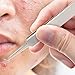 Equinox Blackhead Remover Tool, Pro-Grade Curved Tip Comedone Tweezer, Surgical-Grade Stainless Steel, Blemish Extractor for Blackheads, Whiteheads, and Clogged Pores, Pimple Popper