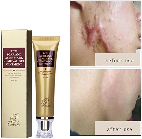 Acne Scar Removal Cream,HUBEE Face Skin Repair Cream,Acne Spots Treatment,Blackhead Whitening Cream Stretch Marks,for face & the whole body (30g) (A01)