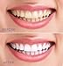 Aliceva Teeth Whitening Pen - Natural & Safe Tooth Whitener Treatment with Active Oxygen & 35% Carbamide Peroxide Gel - Mint Flavor