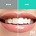 Just Pure Hut Teeth Whitening Gel Pen - Whitener Kit 35% Carbamide Peroxide