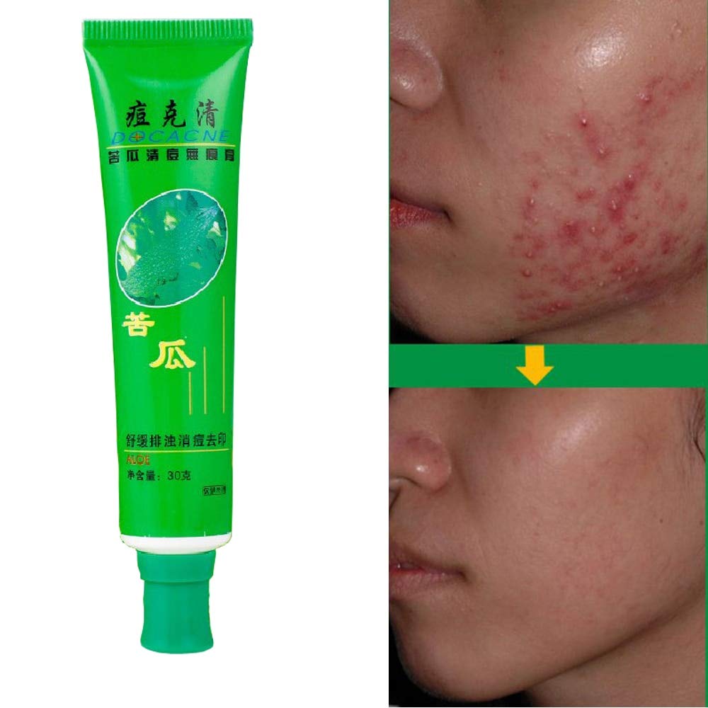 Buy Generic AntiAcne Cream Ointment Acne Removal Unguent Acne