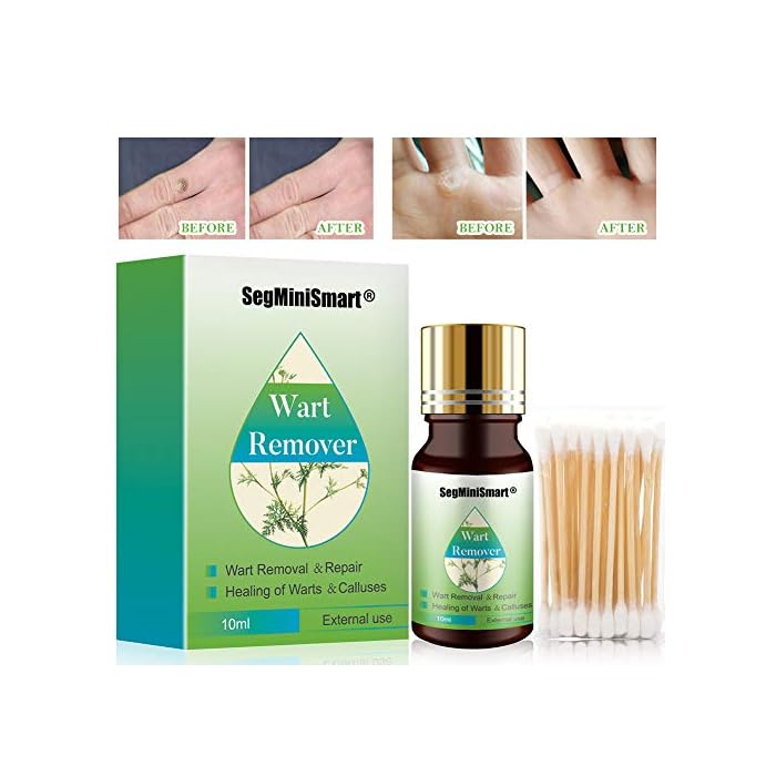 Wart Remover, Stops Wart Regrowth, Wart Removal, Painlessly Removes Common and Plantar Warts
