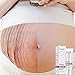 Enjoyment Scars Removal Cream Stretch Marks Cream Pregnancy Skin Care Belly Butter - Plant Nutrition Repair Ingredients to Help Prevent & Reduce Stretch Marks, 40G/1.4oz