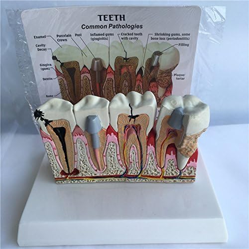Desk Type,anat Diseases (Common Pathologies) Teeth Model w/d escription Plate
