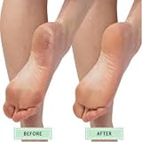 Citystores Pumice Stone Feet Callus Remover Dry Hard Skin Cracked Heels view 6