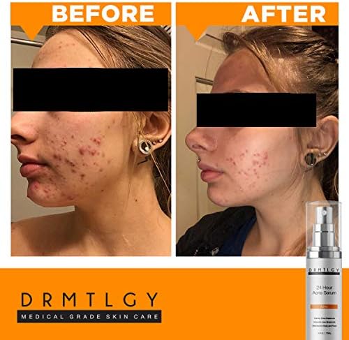 celia blackhead remover