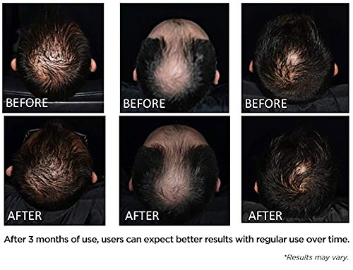 Irestore Anti Hair Loss Serum W Redensyl And Vitamin E B