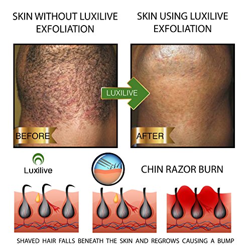 Luxilive Exfoliator Brush Ingrown Hair Stainless Steel Tweezer