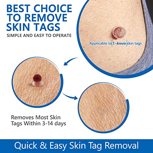 2 Size Automatic Removal Pen Set, Effective, Painless, Easy And Safe For Small To Large Size Warts And Moles (1-9 MM)