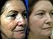 50% TCA Chemical Skin Peel - Tattoo remover, Age Spots, Skin Tags, Warts, Moles (Various Strengths) (50% / 4ml) by RePare, LLC