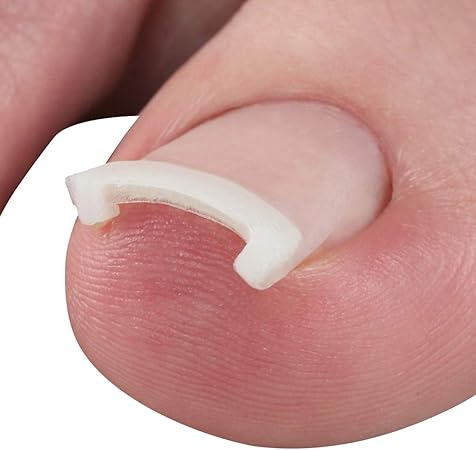 Amazon サイプラス プラスウォーク 一般医療機器 巻き爪矯正シール プラスウォーク 巻き爪テープ 通販