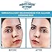 Acne Spot Treatment Serum - Quickly Fights And Treat Acne Breakouts, Pimples, Whiteheads & Blackheads. Dissolves Away Pore Clogging Oils without Over Drying your Skin.