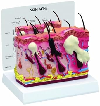Amazon.com: Skin Acne Anatomical Model Normal/Acne Cross-Section