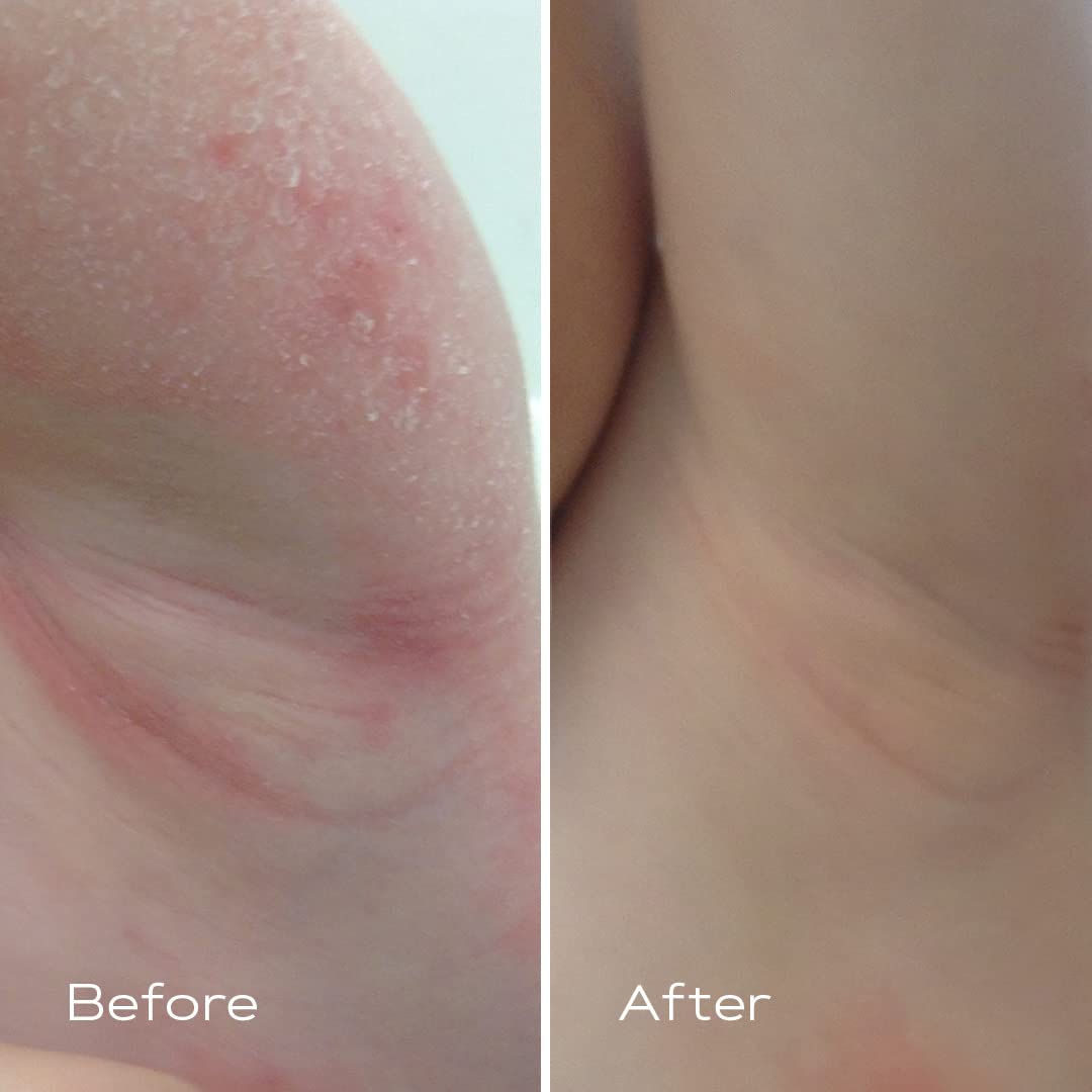 KAMEDIS Eczema Therapy Soothing Body Cream. Botanicals-Based. Clinically Proven for Itchy, Dry, Irritated Skin. Dermatologist Recommended moisturizing Treatment. SLS & paraben-Free.