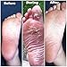 Foot Peel Mask, Results 100% Guaranteed Remove Cracked Heels, Calluses and Dry Skin, Get Beautiful Baby Feet in 7 Days - Foot Peeling Mask (1-Pack Original)