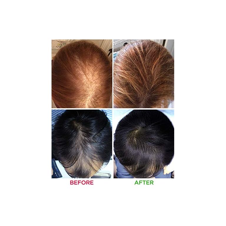 Fda laser hair growth