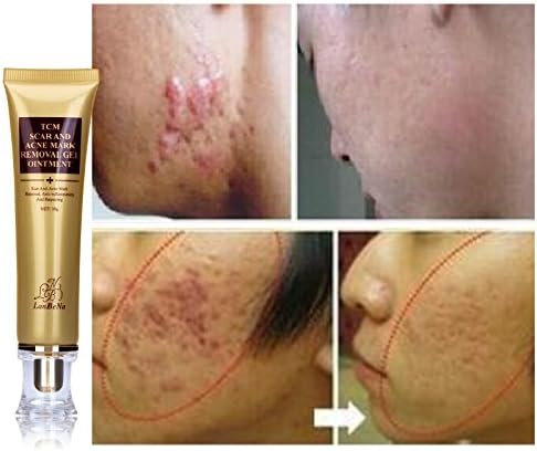 Designeez Ginseng Extract Against Black Dots Scar Removal Facial Blackhead Bleaching Cream - 30Ml