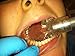 Kona Adapter 2.0 Kit - Attach **Isolite** Dental Mouthpieces Directly to your HVE valve
