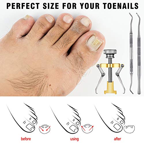 Ingrown Toenail Tools Include Ingrown Toenail Lifter Ingrown Toenail